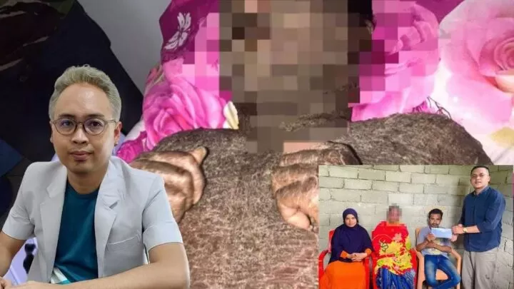 Sempat Viral, Kulit Pria Asal Bombana Bersisik Usai Minum Obat Pemutih Kulit, Ternyata Ini Penyebabnya Pria asal Bomba