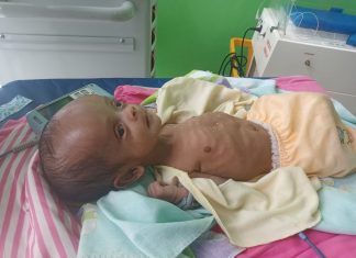 Miris, Bayi 1 Bulan Mengalami Pembesaran di Bagian Kepala, Butuh Perhatian Pemkab Jeneponto