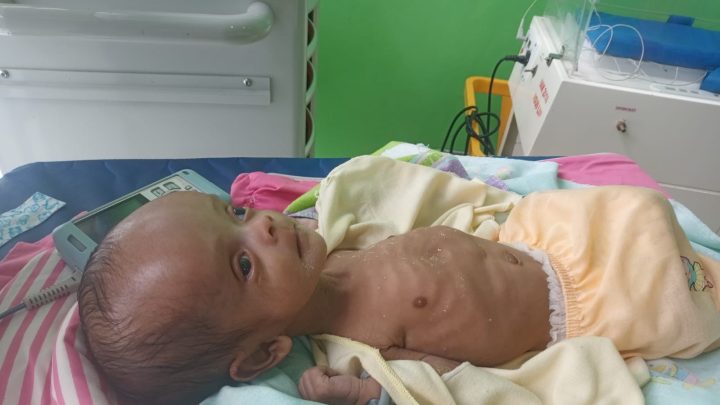 Miris, Bayi 1 Bulan Mengalami Pembesaran di Bagian Kepala, Butuh Perhatian Pemkab Jeneponto Bayi 1 Bulan